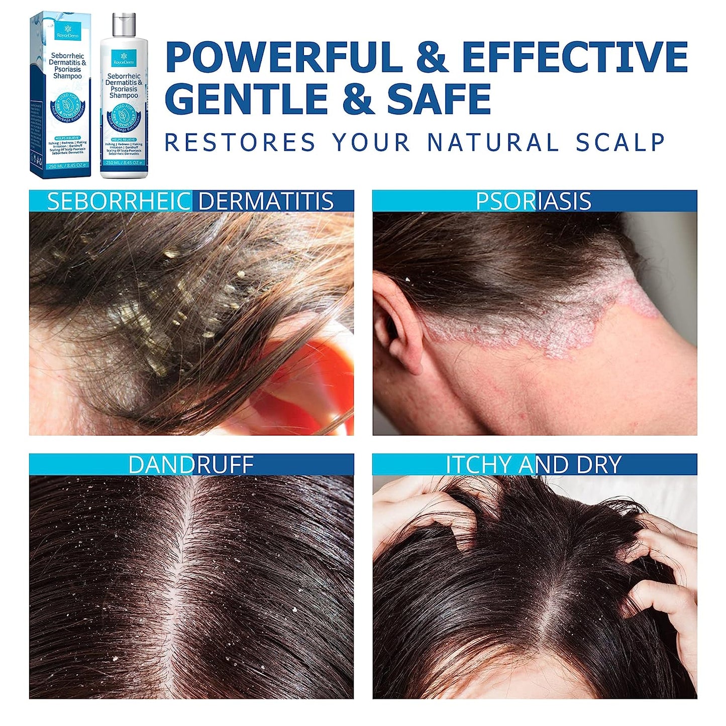 RoyceDerm Seborrheic Dermatitis And Psoriasis Shampoo 250mL / 8.45 oz