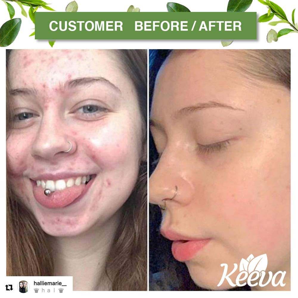 Keeva Organics Tea Tree Oil Acne Treatment Cream With Essential Oils, 1 oz.