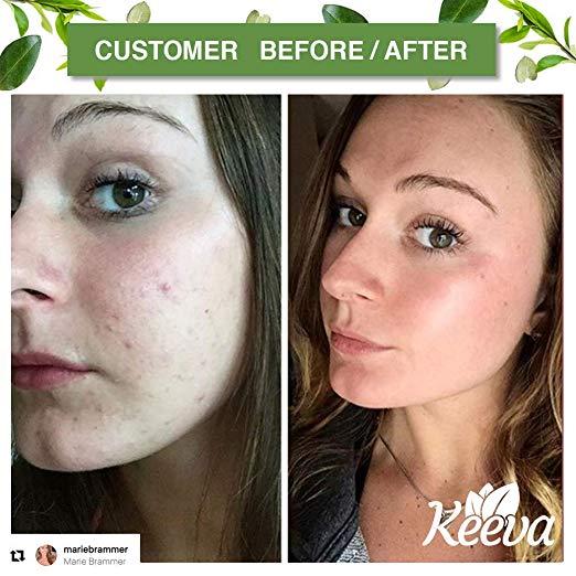 Keeva Organics Acne Treatment Cream With Secret Tea Tree Oil Formula 2 oz