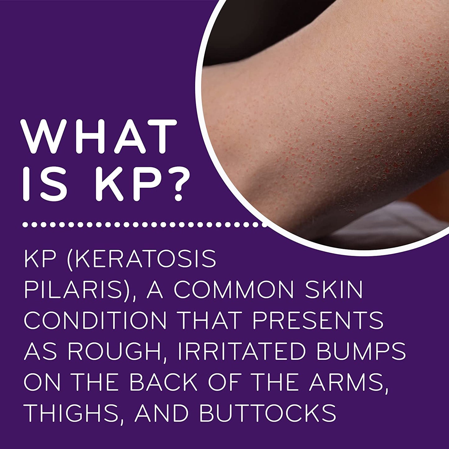 AmLactin KP Bumps Be Gone 15% Lactic Acid Hydrating Cream For Rough & Bumpy Dry Skin - 85g (PACKAGING MAY VARY)