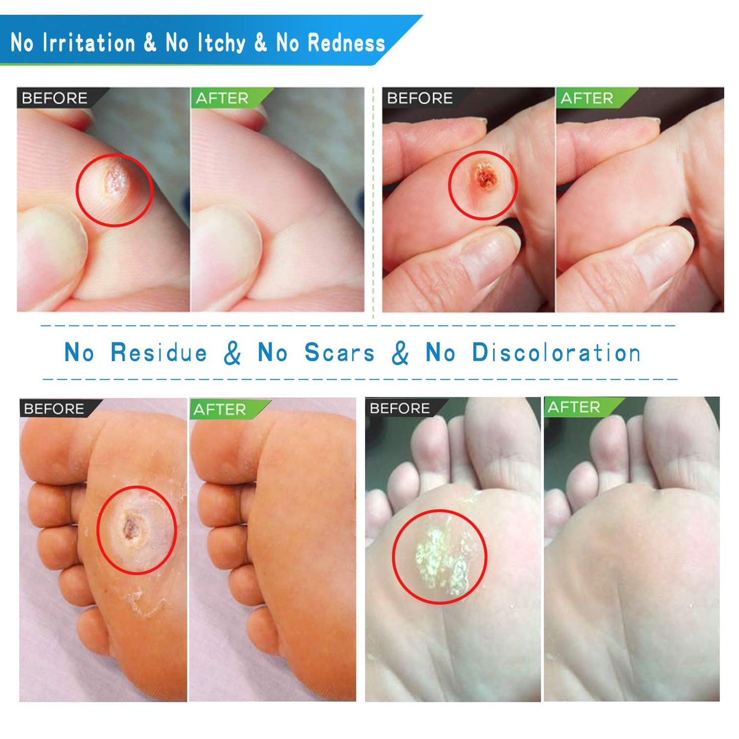 Corn Remover for Feet, Removes Callus, Toe Corns Fast, While Giving you Treatment and Protection, Goodbye to Footpain, Works for All Foot Size (42Pads)