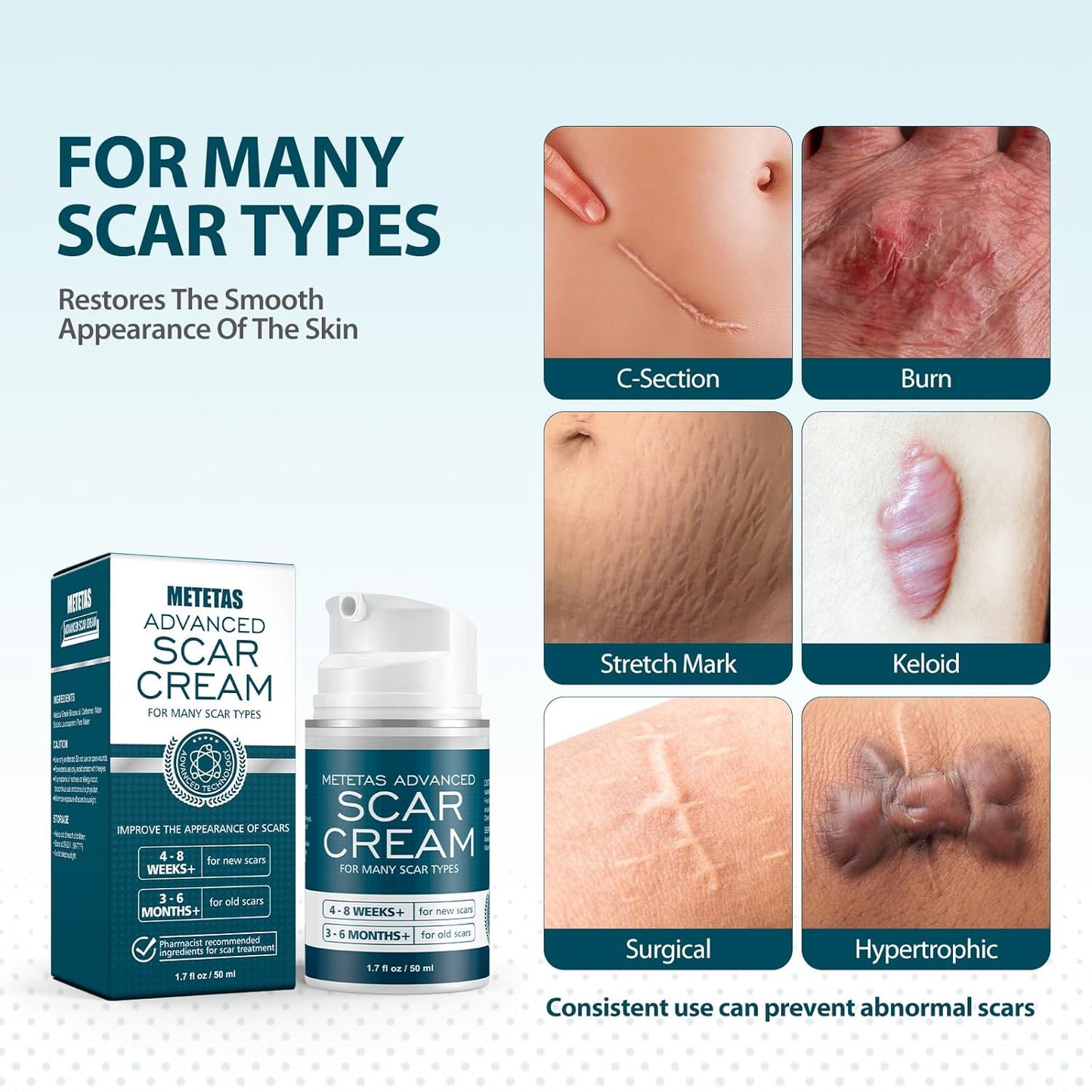 Metetas Advanced Scar Cream 1.7 fl oz / 50ml