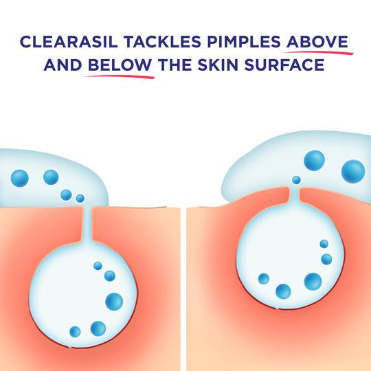 Clearasil Stubborn Acne Control 5-in-1 Maximum Strength Cream, 1 oz. / 28 g