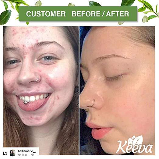 Keeva Organics Acne Treatment Cream With Secret Tea Tree Oil Formula 2 oz