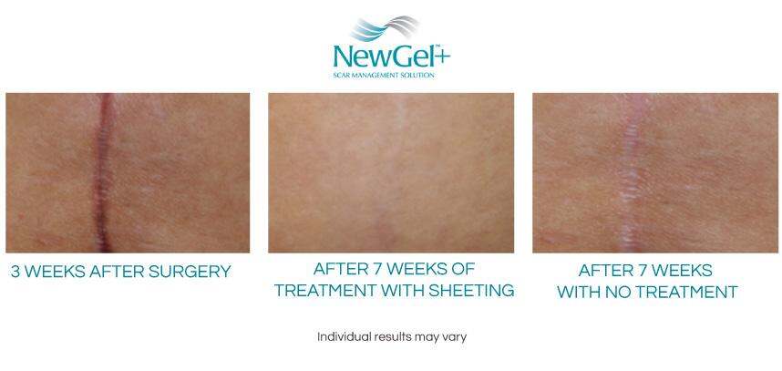 New Gel+ E Advanced Silicone Gel for Scars 30 g