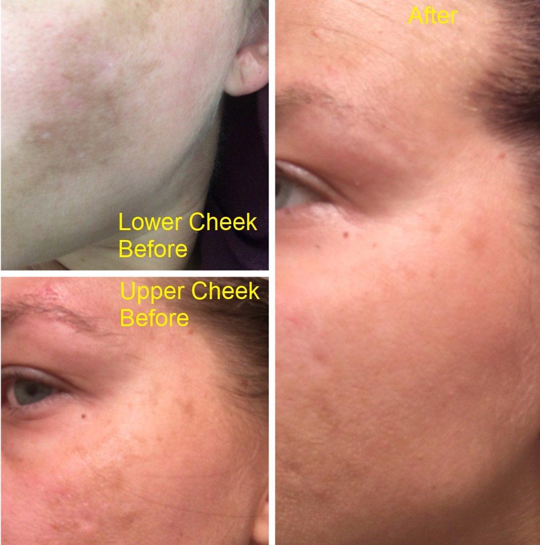 Admire My Skin Ultra-Potent Brightening Serum 1% Synovea with Kojic, Azelaic, Lactic & Salicylic Acid, 1 fl.oz / 30ml