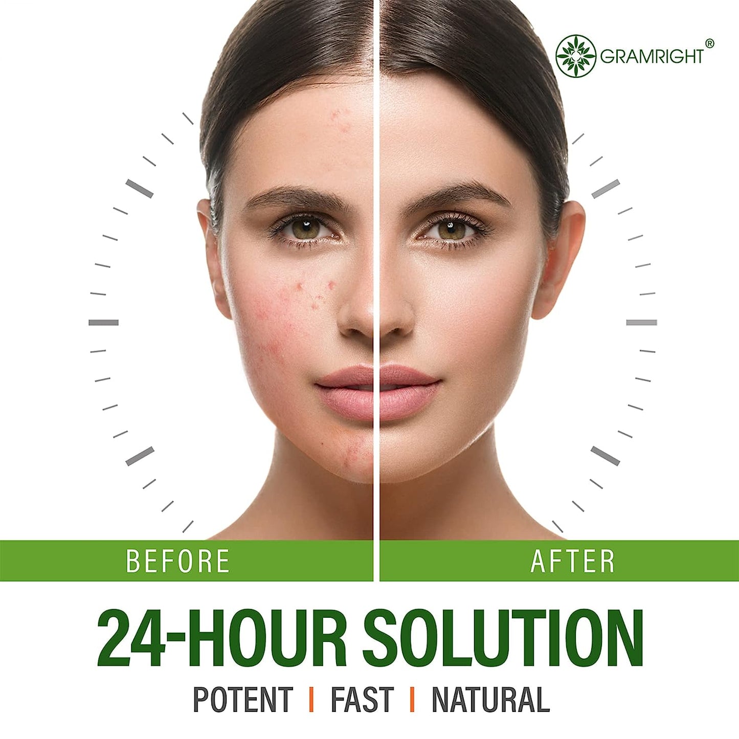 Gramright Acne Treatment Face Cream 4 fl.oz