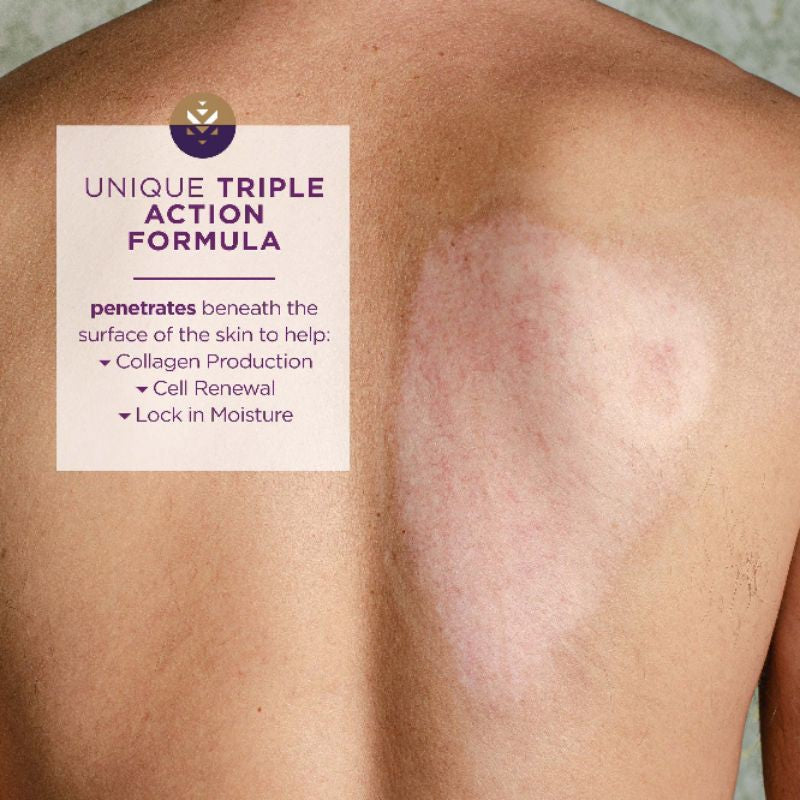 Mederma Advanced Scar Gel Treatment, 0.7 oz. / 20g