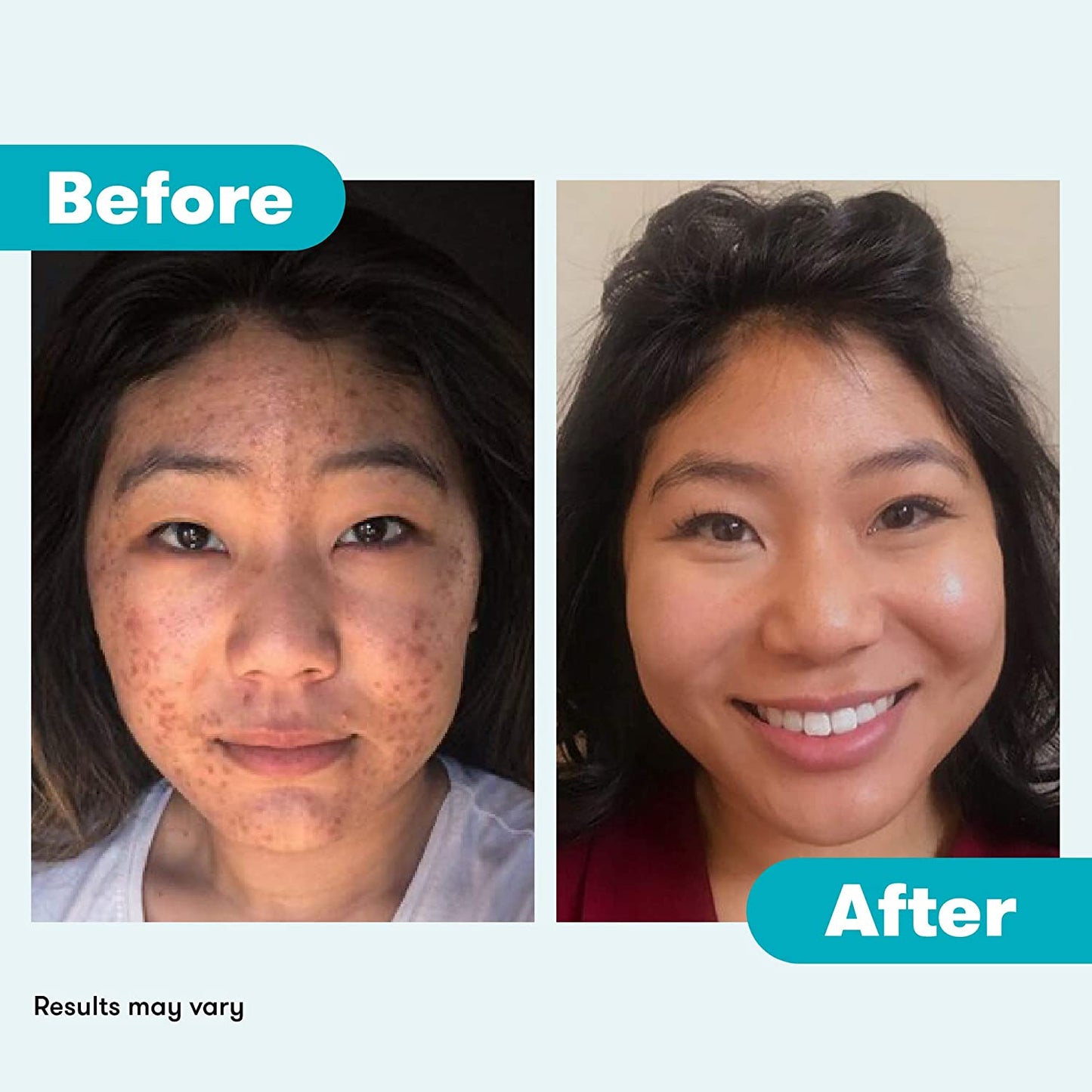 Proactiv+ 3 Step Advanced Skincare Acne Treatment, Benzoyl Peroxide Face Wash