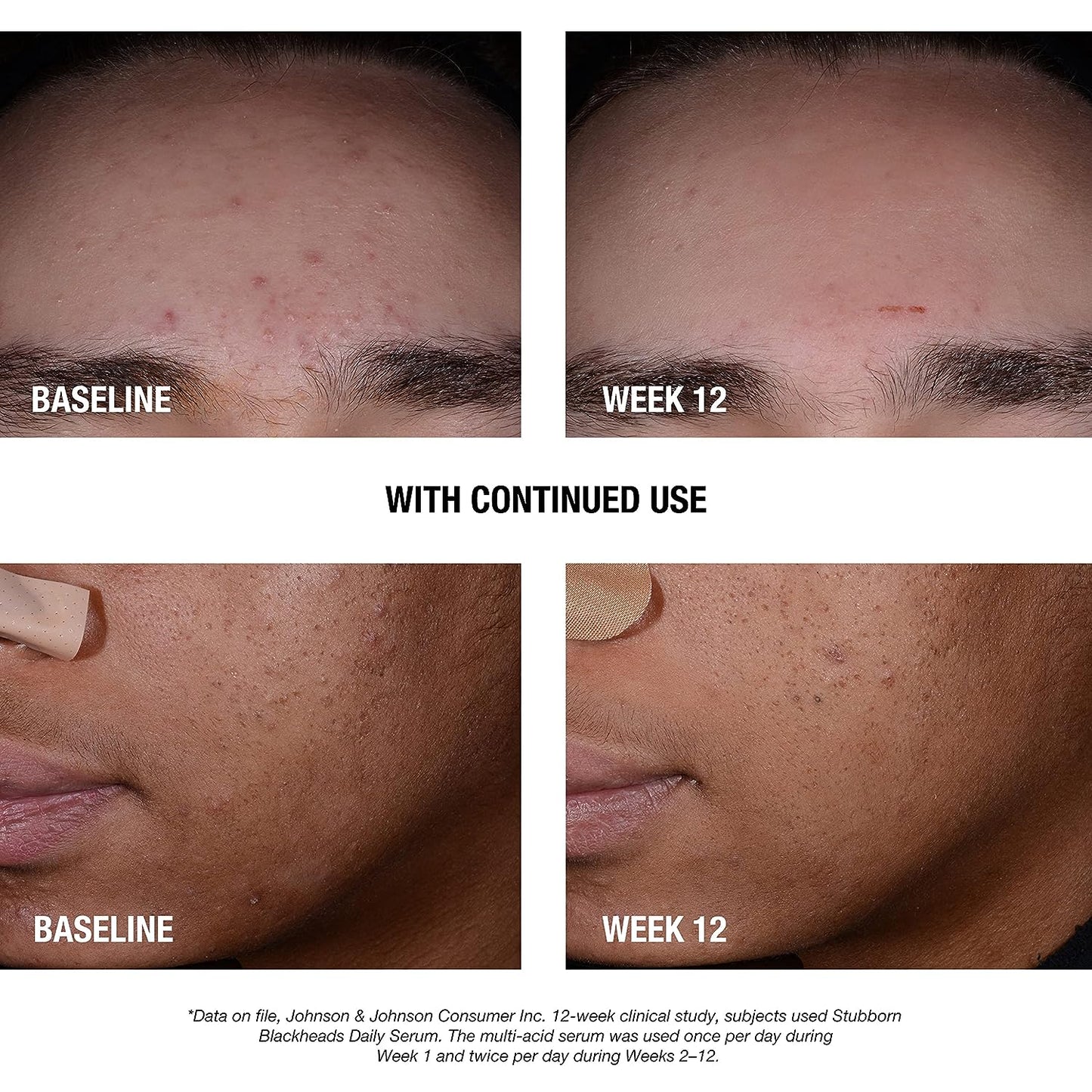 Neutrogena Stubborn Blackheads Daily Serum Acne Treatment 30ml