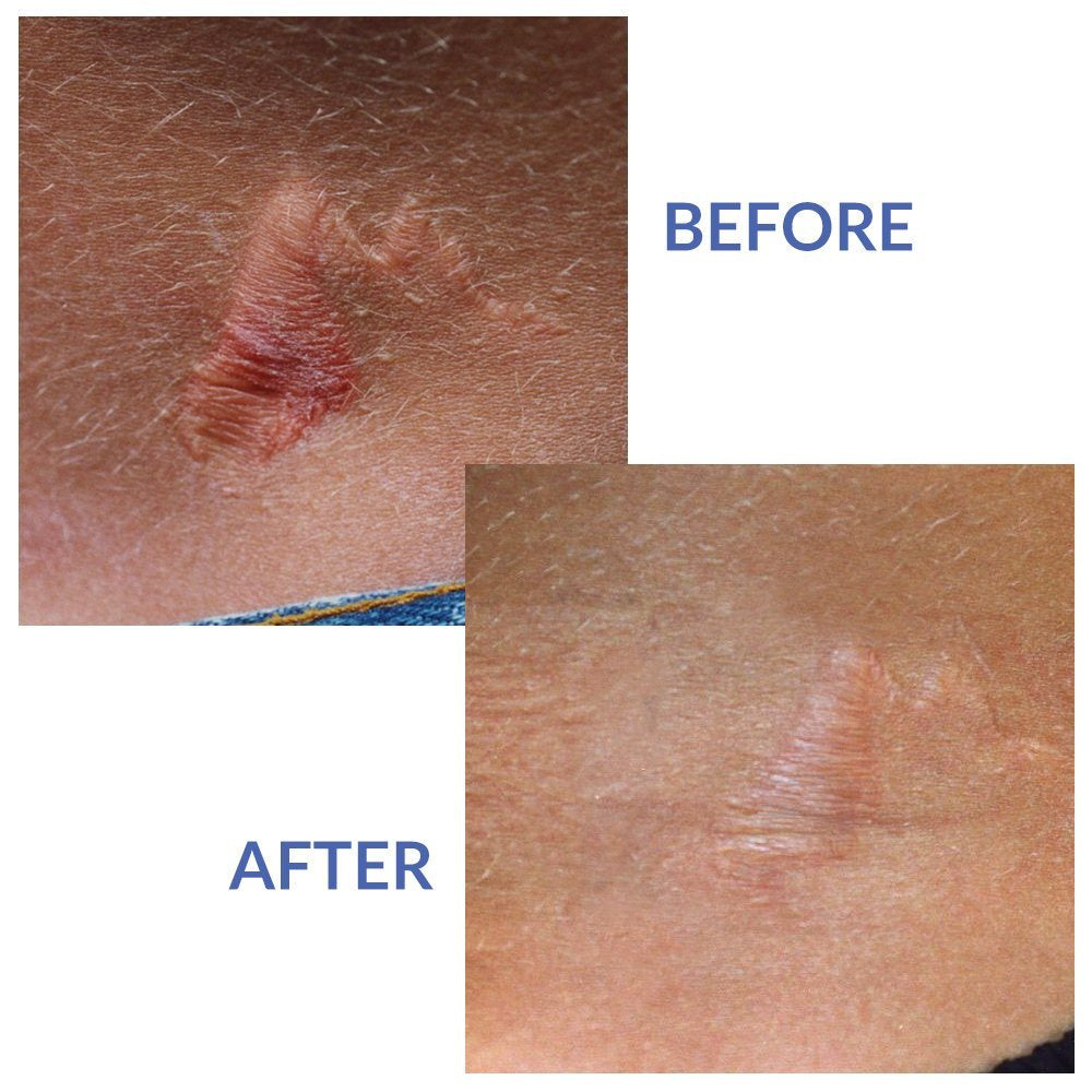 Xeragel 100% Silicone Ointment for Scars Reduce the Appearance of Old & New Scars, 0.33 oz. / 10g