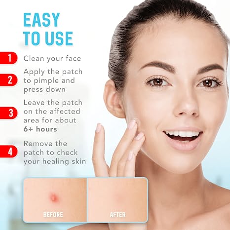 KeyConcepts Emergency Acne Patches Invisibly Cover Blemishes Heals Quickly 120 Counts