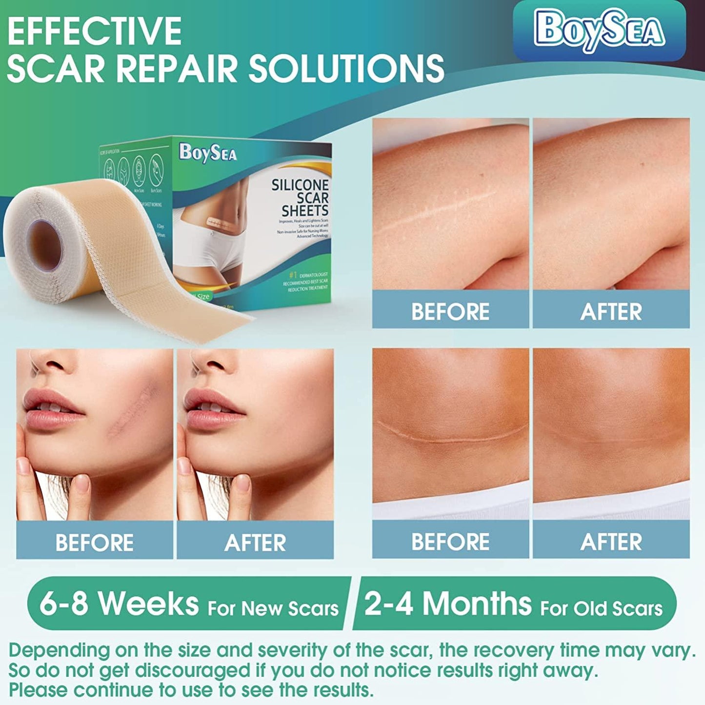 BoySea Silicone Scar Sheets Roll Size 1.6" x 150" / 4cmX3.8cm