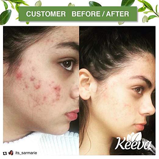 Keeva Organics Acne Treatment Cream With Secret Tea Tree Oil Formula 2 oz