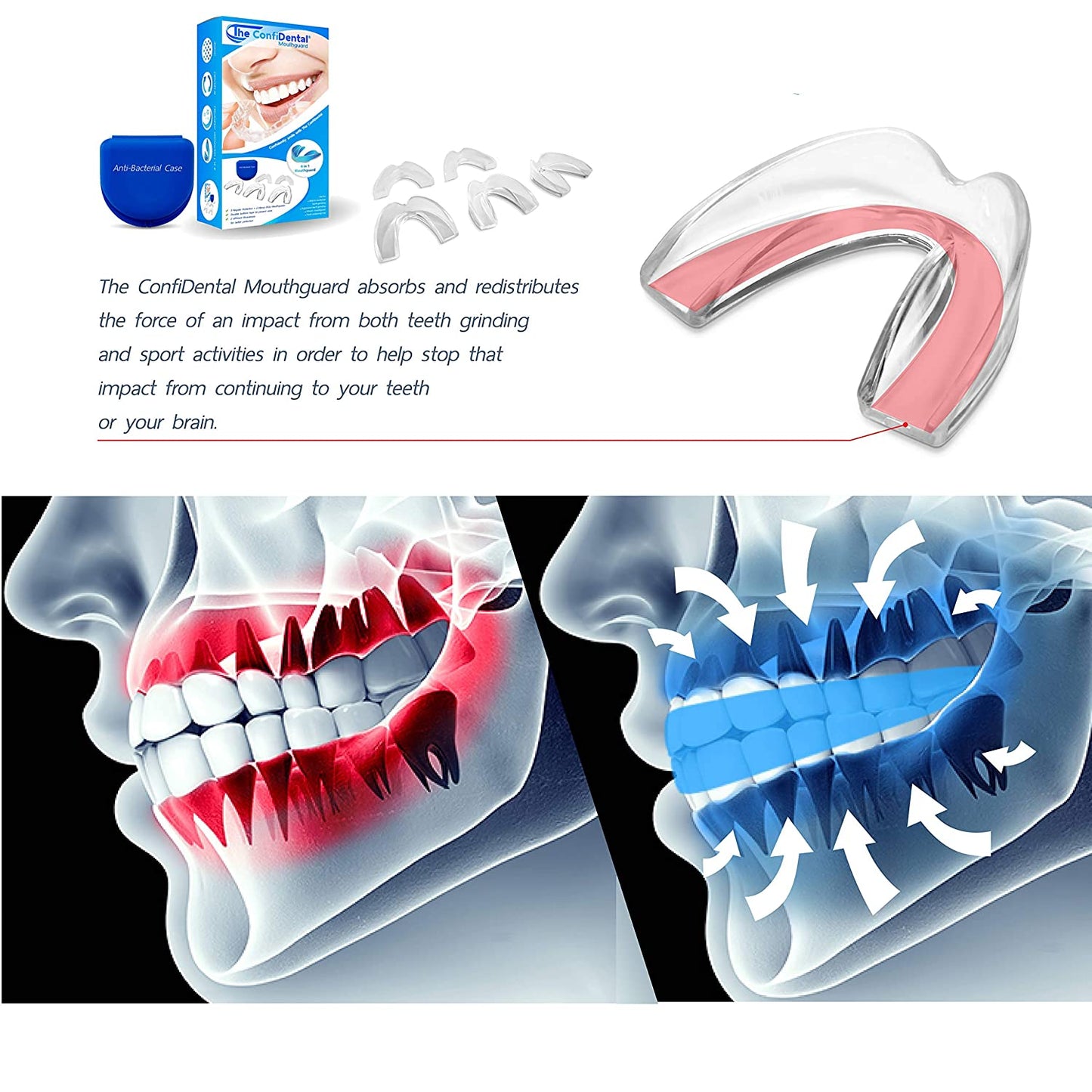 The ConfiDental Pack of 5 Moldable Mouth Guard Includes 3 Regular and 2 Heavy Duty Guard