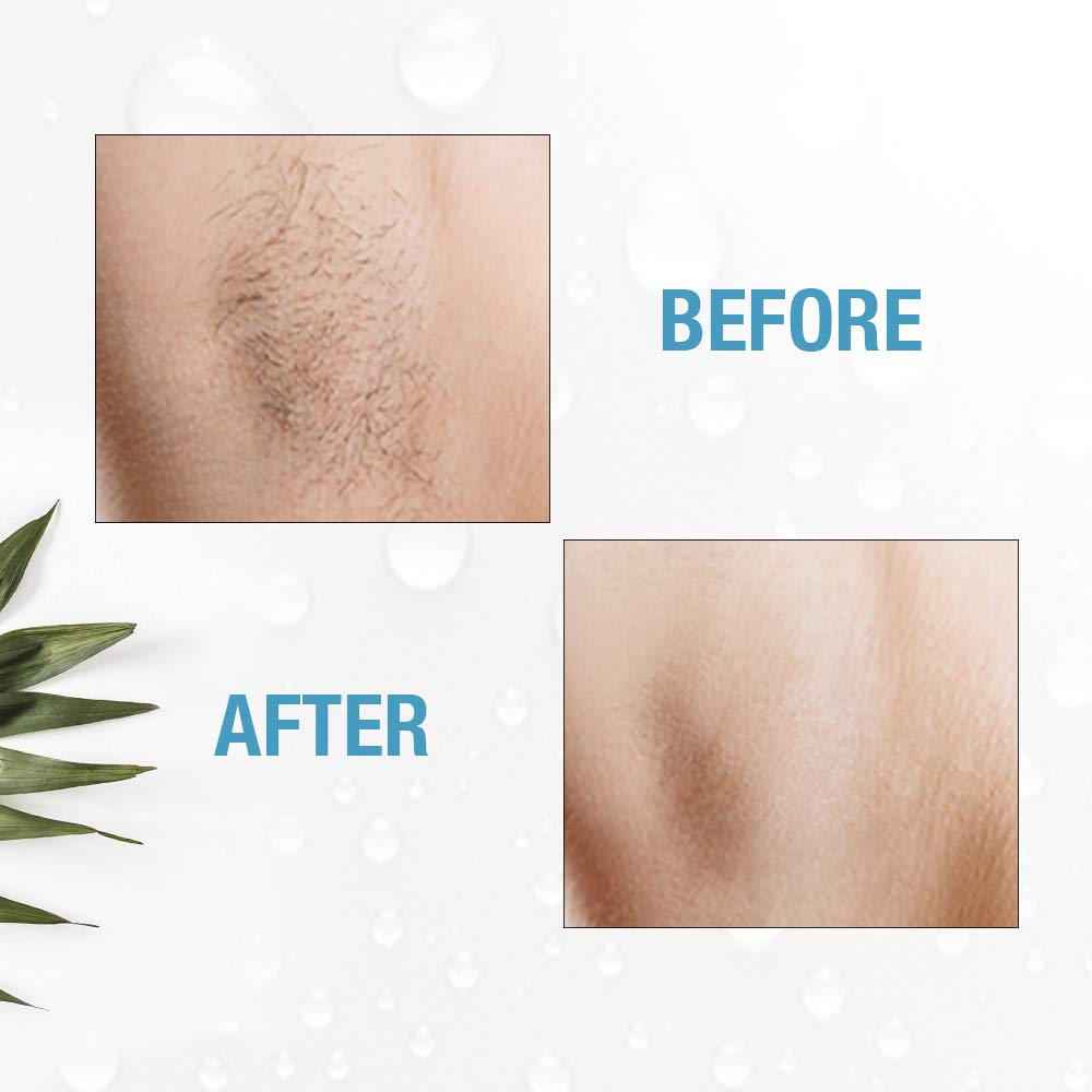 Clean + Easy Personal Non-Laser Personal Electrolysis for Face + Body Removes Unwanted Hair for Home Use