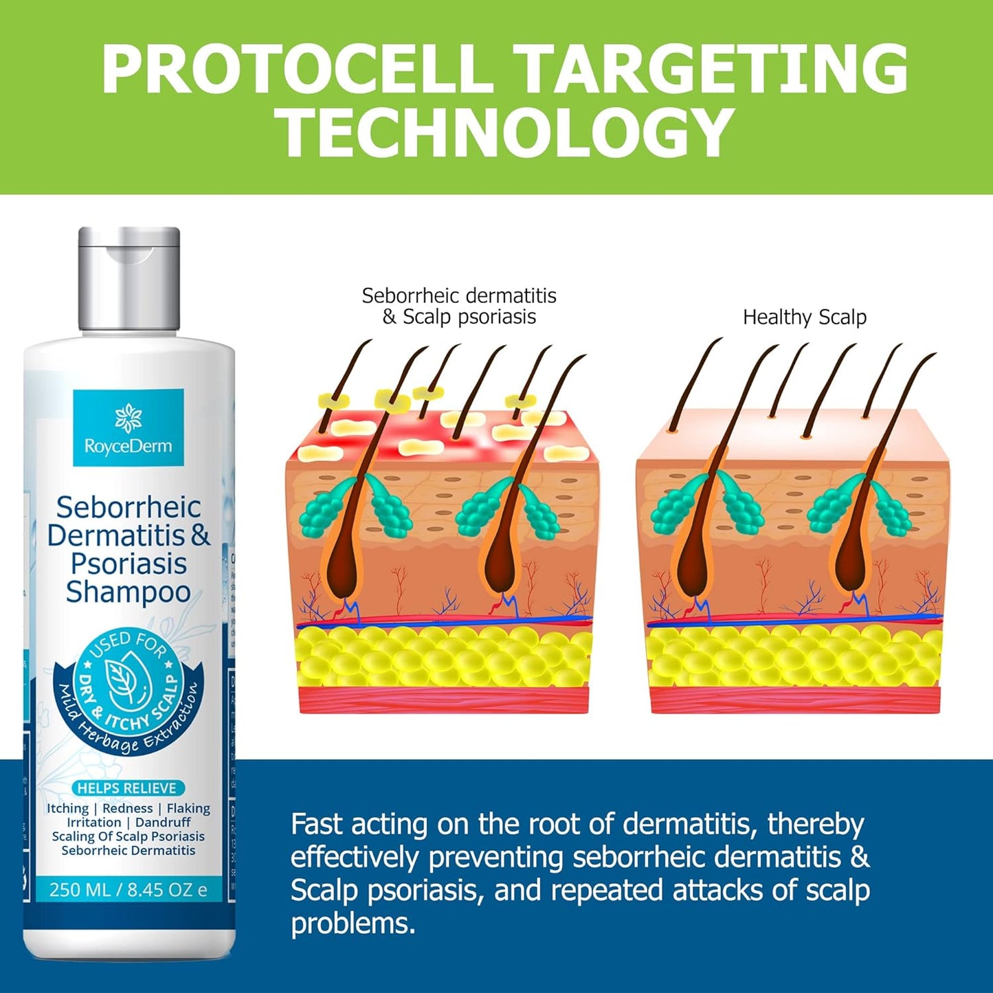 RoyceDerm Seborrheic Dermatitis And Psoriasis Shampoo 250mL / 8.45 oz