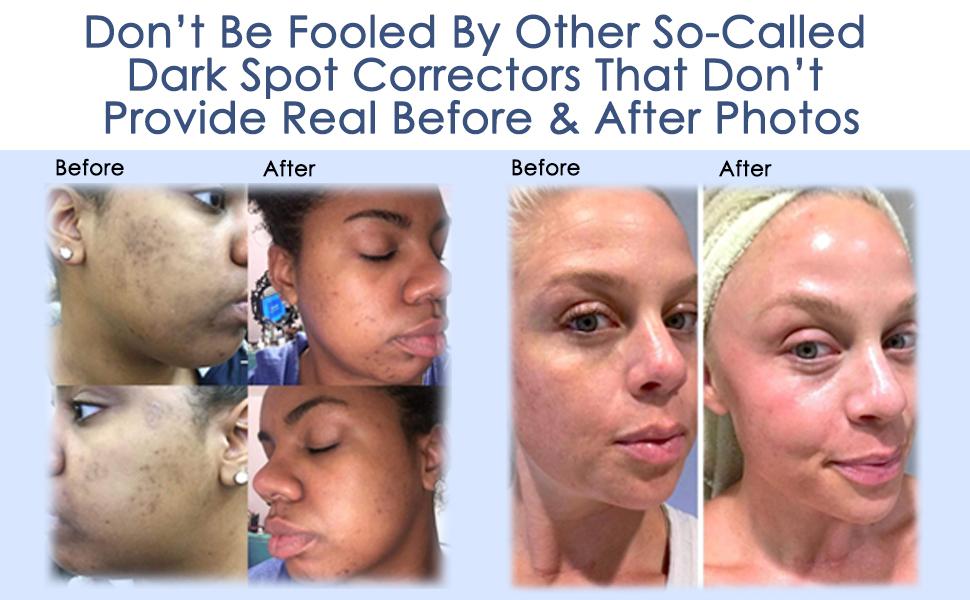 Admire My Skin Ultra-Potent Brightening Serum 1% Synovea with Kojic, Azelaic, Lactic & Salicylic Acid, 1 fl.oz / 30ml