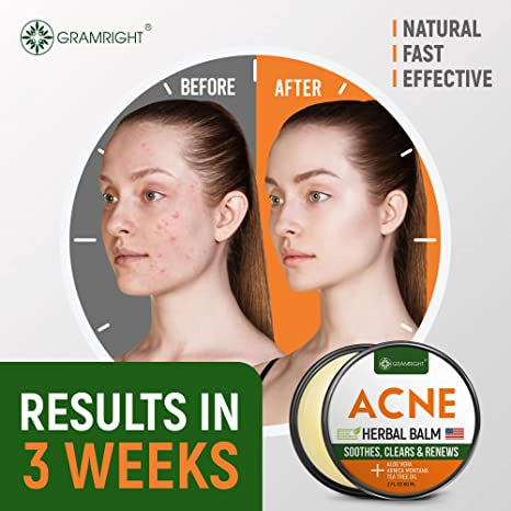Gram Right Acne Herbal Balm Soothies, Ckears & Renews Made With Natural Ingredients 2 Fl Oz (60ml)